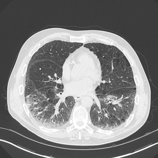 Caplan syndrome (Radiopaedia 56667-63530 Axial lung window 122).jpg