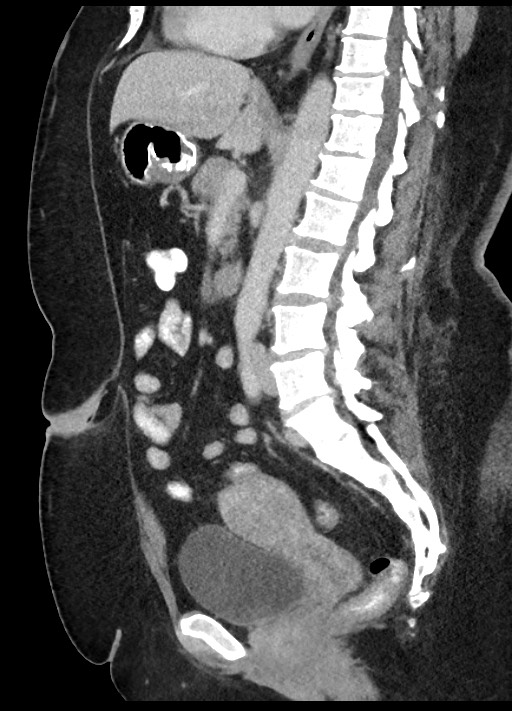 Carcinoid tumor - terminal ileum (Radiopaedia 60931-68739 C 46).jpg