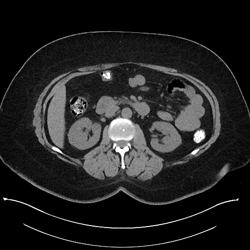 Carcinoid tumor - terminal ileum (Radiopaedia 60931-68740 Axial non-contrast 45).jpg