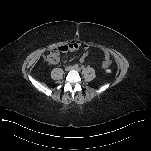 Carcinoid tumor - terminal ileum (Radiopaedia 60931-68740 Axial non-contrast 75).jpg