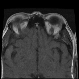 File:Carcinoid tumor of the ileum with metastasis to orbit (Radiopaedia 28165-28424 Axial T1 7).jpg