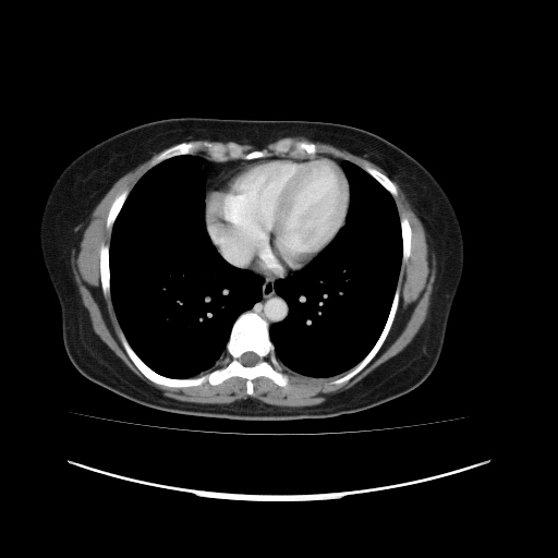 File:Carcinoma colon - hepatic flexure (Radiopaedia 19461-19493 A 7).jpg