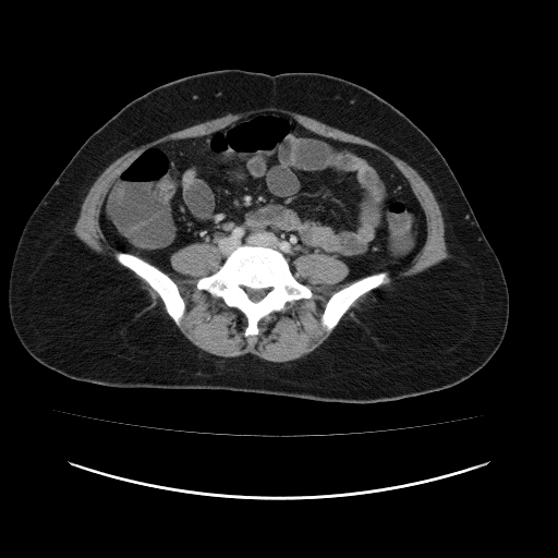 Carcinoma colon - hepatic flexure (Radiopaedia 19461-19493 A 83).jpg