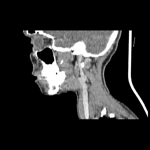 Carcinoma of the maxillary antrum (Radiopaedia 53805-59888 Sagittal C+ delayed 130).jpg