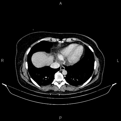 Carcinoma of uterine cervix (Radiopaedia 85861-101700 A 27).jpg