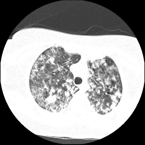 Cardiac angiosarcoma (Radiopaedia 66010-75181 Axial lung window 71).jpg