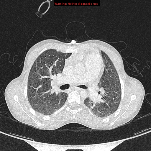 File:Cardiac bronchus (Radiopaedia 14059-13899 A 12).jpg