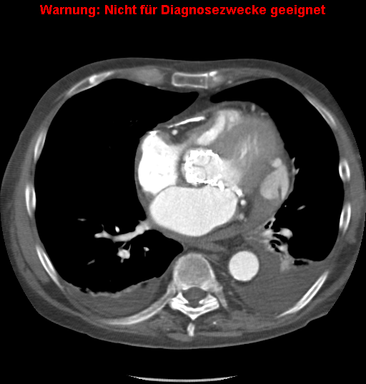 File:Cardiac perforation following transcatheter aortic valve implantation (Radiopaedia 23714-23863 A 6).png