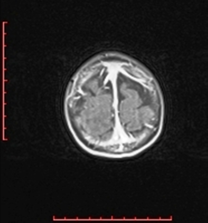 Cardiac rhabdomyoma - tuberous sclerosis (Radiopaedia 70089-80114 Axial T1 C+ fat sat 102).jpg