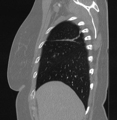 File:Cardiac sarcoidosis (Radiopaedia 74548-85534 Sagittal lung window 79).jpg