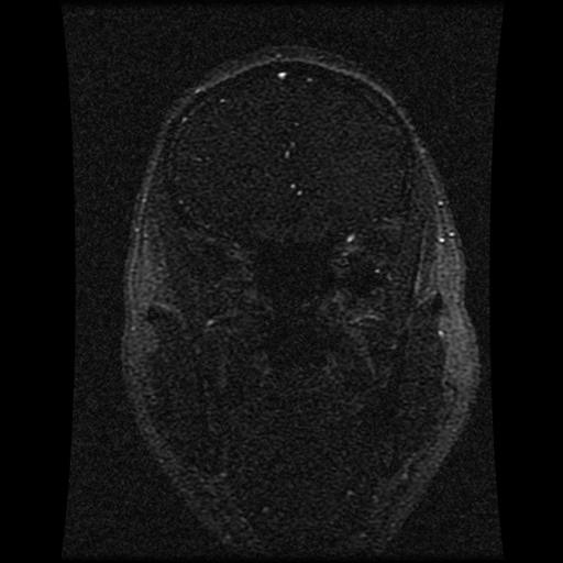File:Carotid arterial dissection with acute cerebral infarction (Radiopaedia 26636-26784 MRV 121).jpg