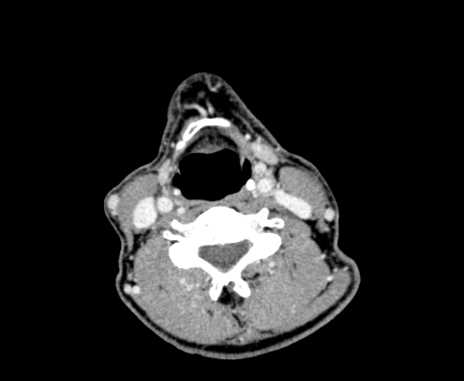 Carotid body tumor (Radiopaedia 61750-69757 Axial Post contrast 64).jpg