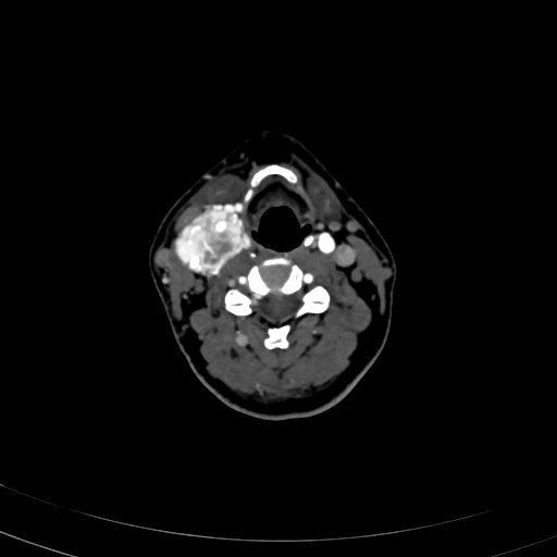 Carotid body tumor (Radiopaedia 83615-98727 A 62).jpg