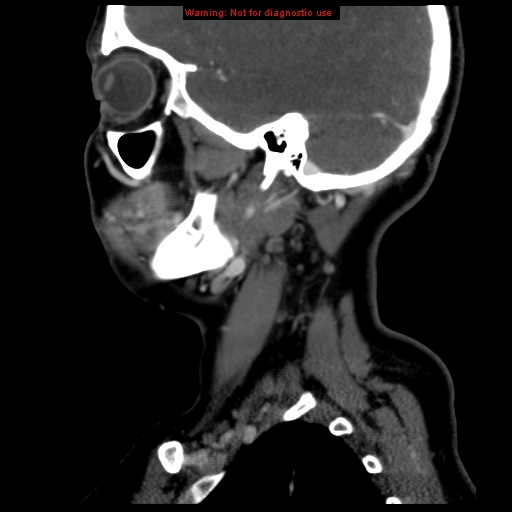 Carotid body tumor with lung metastases (Radiopaedia 9301-9986 Sagittal C+ delayed 11).jpg