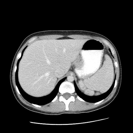 File:Castleman disease with fibrous pseudotumor in the abdomen (Radiopaedia 77296-89373 A 25).jpg