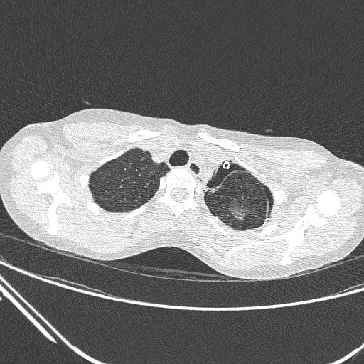 Catamenial pneumothorax (Radiopaedia 27946-28197 lung window 33).jpg