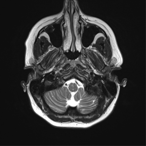 File:Cavernoma with bleed - midbrain (Radiopaedia 54546-60773 Axial T2 5).png