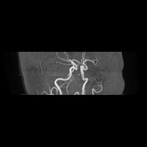 Cavernoma with developmental venous anomaly (Radiopaedia 22470-22507 MRA 14).jpg