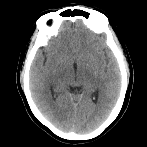 Cavernoma with hemorrhage (Radiopaedia 70755-80931 Axial non-contrast 25).png