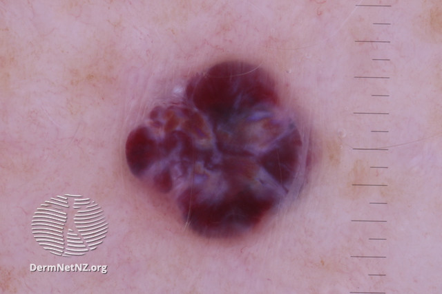 File:Cavernous haemangioma, polarised dermoscopy view (DermNet NZ cavernous-haemangioma-TS-dp).jpg