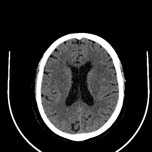 File:Cavernous hemangioma of the cerebellar falx (Radiopaedia 73025-83723 Axial non-contrast 85).jpg