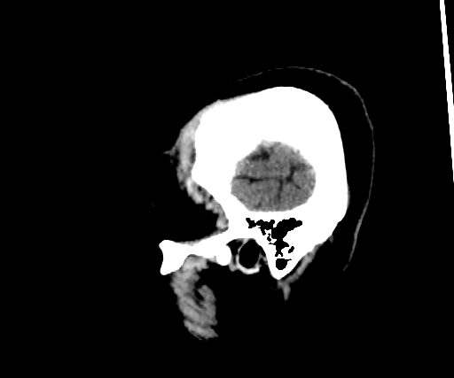 Cavernous hemangioma of the cerebellar falx (Radiopaedia 73025-83723 B 33).jpg