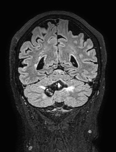 Cavernous hemangioma of the cerebellar falx (Radiopaedia 73025-83724 Coronal FLAIR 258).jpg