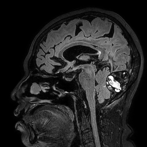 Cavernous hemangioma of the cerebellar falx (Radiopaedia 73025-83724 Sagittal FLAIR 102).jpg