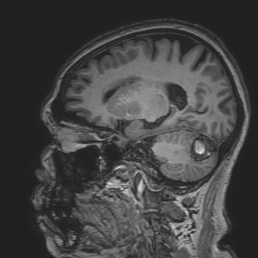 File:Cavernous hemangioma of the cerebellar falx (Radiopaedia 73025-83724 Sagittal T1 80).jpg