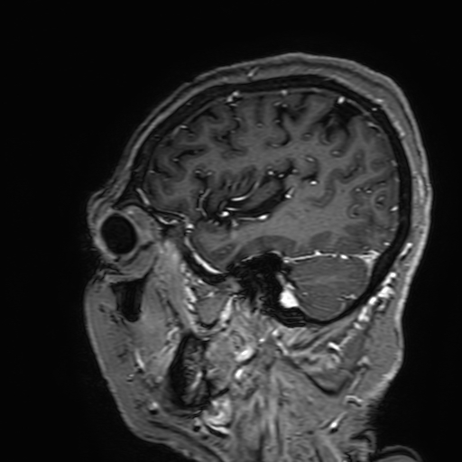 Cavernous hemangioma of the cerebellar falx (Radiopaedia 73025-83724 Sagittal T1 C+ 166).jpg