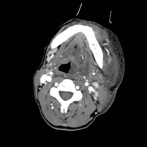 File:Cavernous sinus thrombosis (Radiopaedia 10619-11078 A 17).jpg