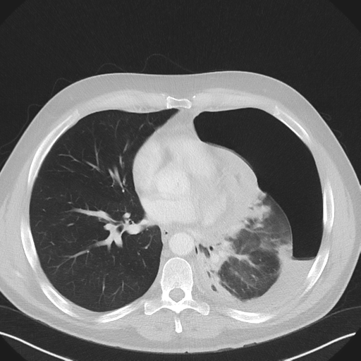 File:Cavitating pneumonia complicated by pneumothorax (Radiopaedia 48149-52994 Axial lung window 40).png