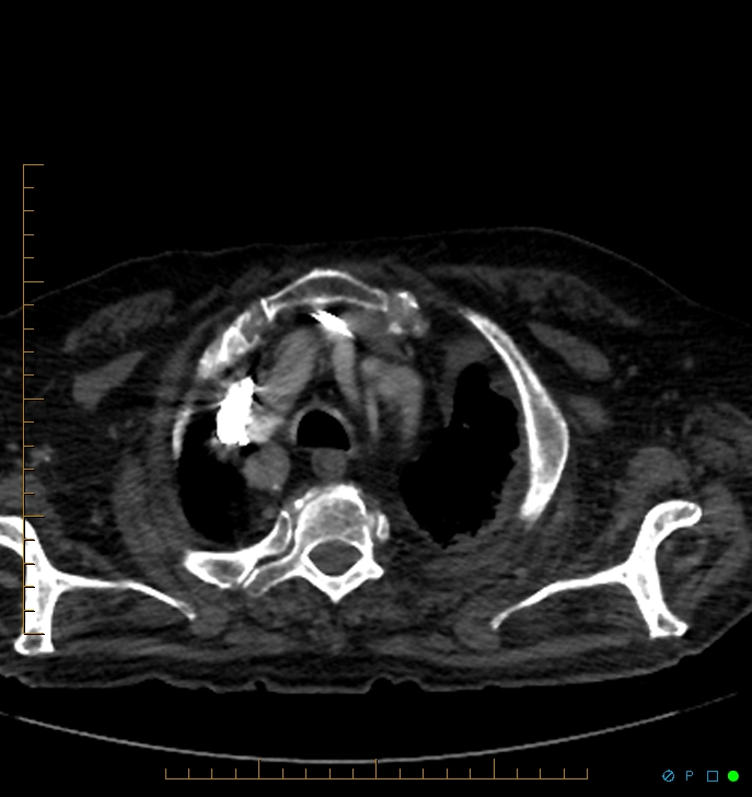 Cavitating pulmonary infarction (Radiopaedia 54634-60849 Axial C+ CTPA 3).jpg