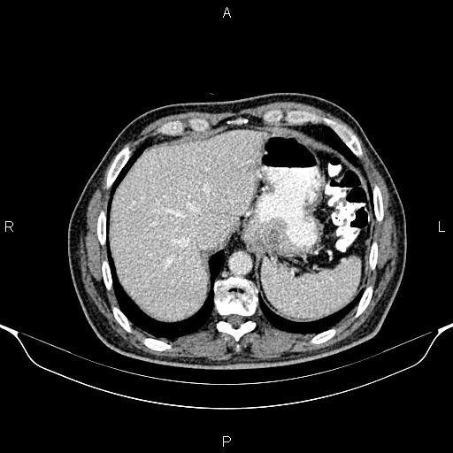 Cecal adenocarcinoma (Radiopaedia 85324-100916 B 14).jpg