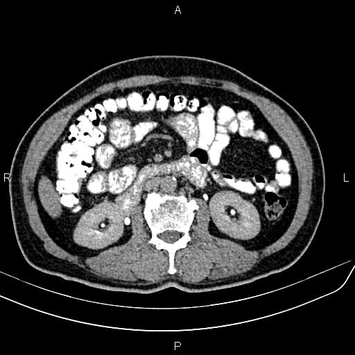 File:Cecal cancer with appendiceal mucocele (Radiopaedia 91080-108651 Axial C+ delayed 28).jpg