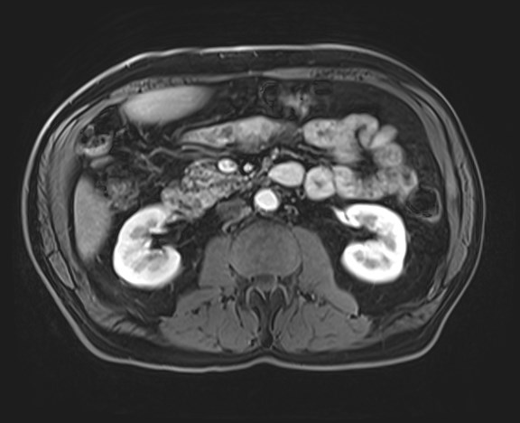 Cecal mass causing appendicitis (Radiopaedia 59207-66532 H 64).jpg