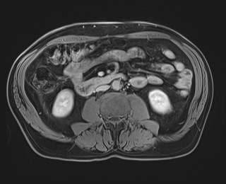 Cecal mass causing appendicitis (Radiopaedia 59207-66532 J 73).jpg