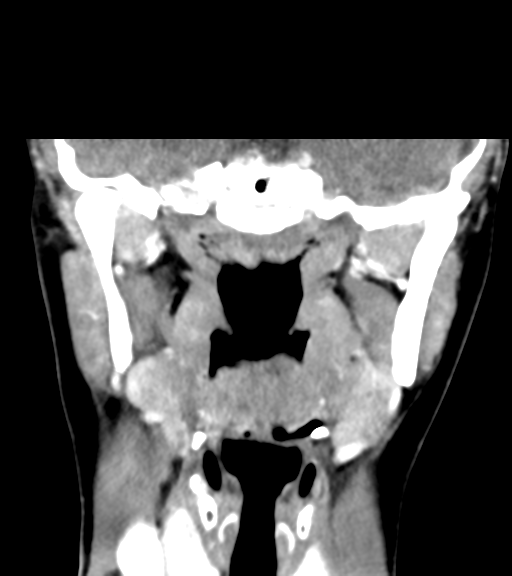 Cemento-ossifying fibroma (Radiopaedia 46243-50643 Coronal C+ delayed 36).png