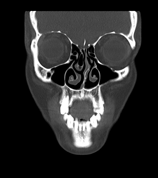 Cemento-ossifying fibroma (Radiopaedia 46243-50643 Coronal bone window 17).png