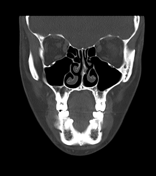 Cemento-ossifying fibroma (Radiopaedia 46243-50643 Coronal bone window 20).png