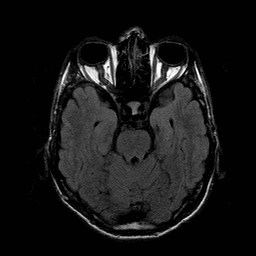 File:Central-variant posterior reversible encephalopathy syndrome (PRES) (Radiopaedia 43880-47359 Axial FLAIR 7).jpg
