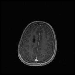 Central neurocytoma (Radiopaedia 30220-30842 Axial T1 C+ 120).jpg
