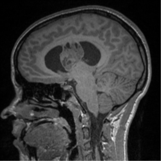 Central neurocytoma (Radiopaedia 37664-39557 Sagittal T1 45).png