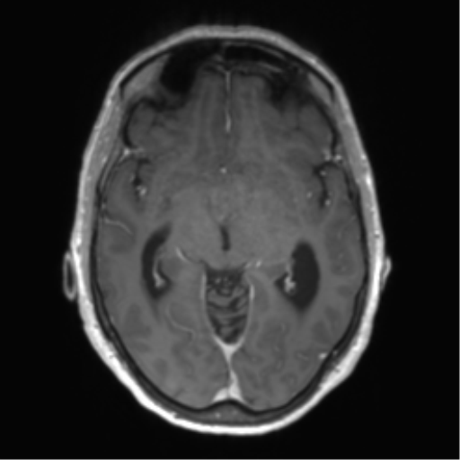 Central neurocytoma (Radiopaedia 65317-74345 Axial T1 C+ 22).png