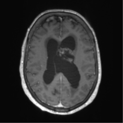 Central neurocytoma (Radiopaedia 65317-74345 Axial T1 C+ 35).png