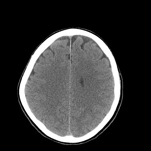 Central neurocytoma (Radiopaedia 68725-78432 Axial non-contrast 36).jpg