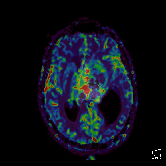 Central neurocytoma (Radiopaedia 84497-99872 Axial Perfusion 157).jpg