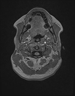 Central neurocytoma (Radiopaedia 84497-99872 Axial T1 13).jpg