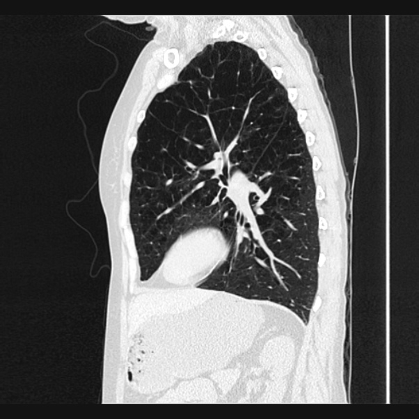 Centrilobular pulmonary emphysema (Radiopaedia 24495-24789 Sagittal lung window 56).jpg