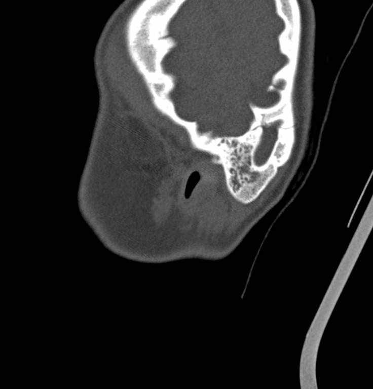 Cerebellar abscess (Radiopaedia 73727-84527 Sagittal bone window 41).jpg
